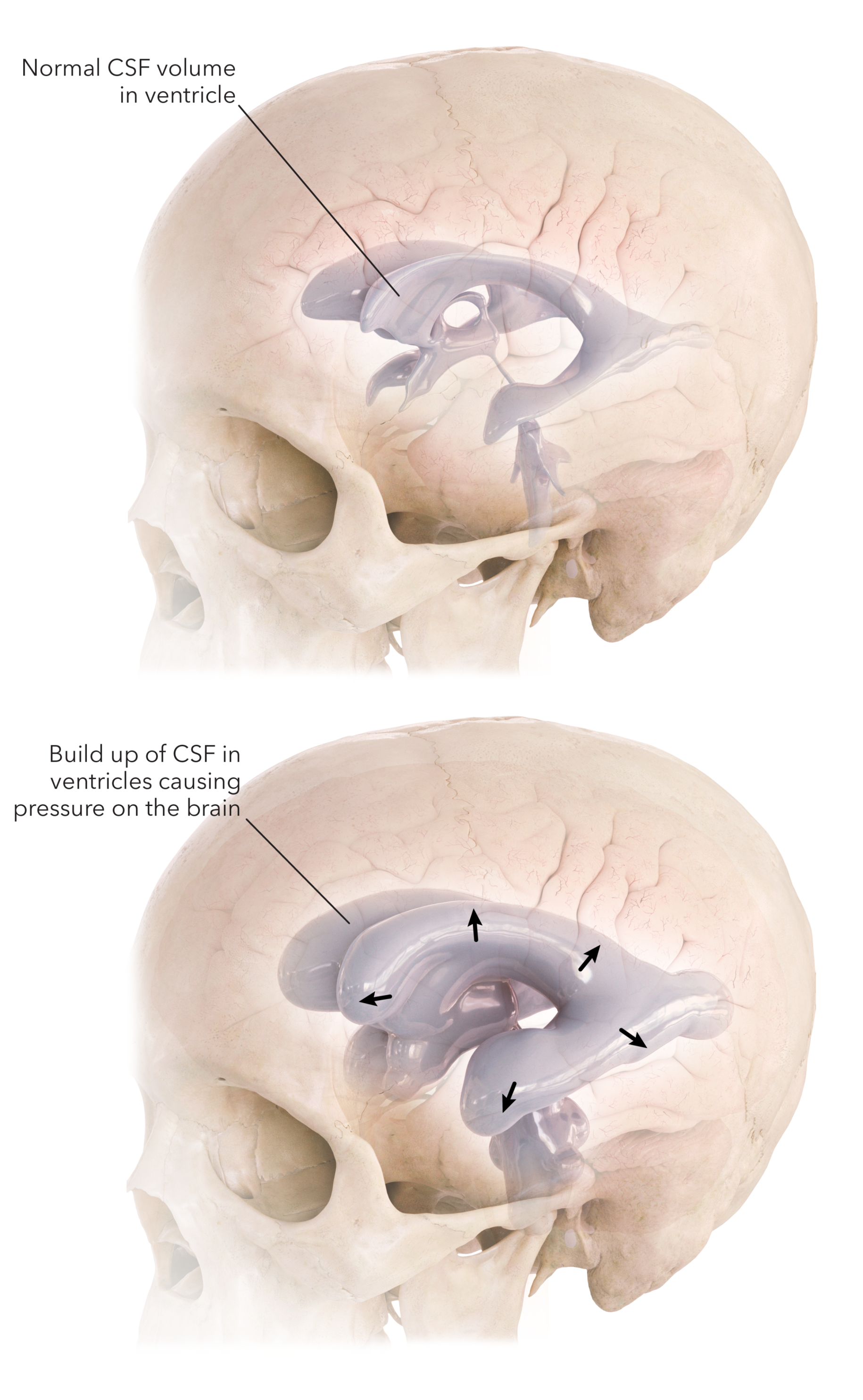 
                                    
                                        Figure 3: When cerebrospinal fluid (CSF) is unable to drain properly, pressure builds within the ventricles and is exerted on the brain.
                                    
                                