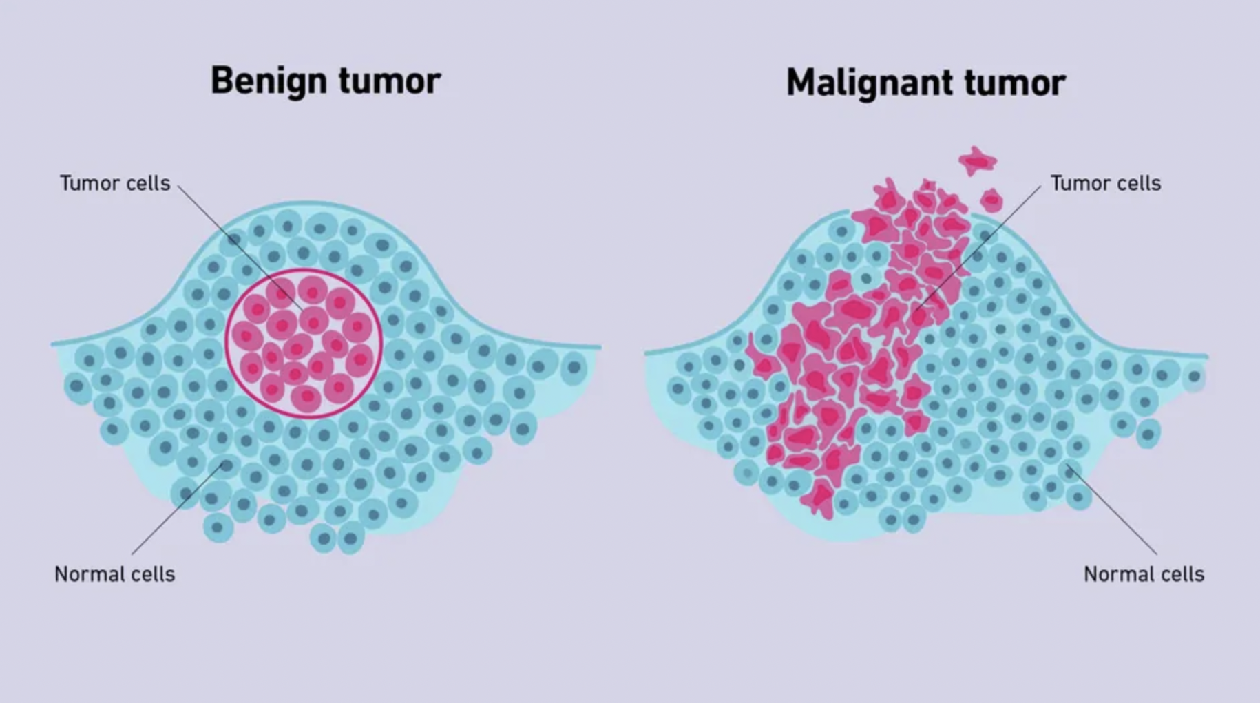 Figure 1: Benign tumors (left) are a slow growing collection of cells that are not invasive to normal cells. Malignant tumors (right) invade healthy tissue.