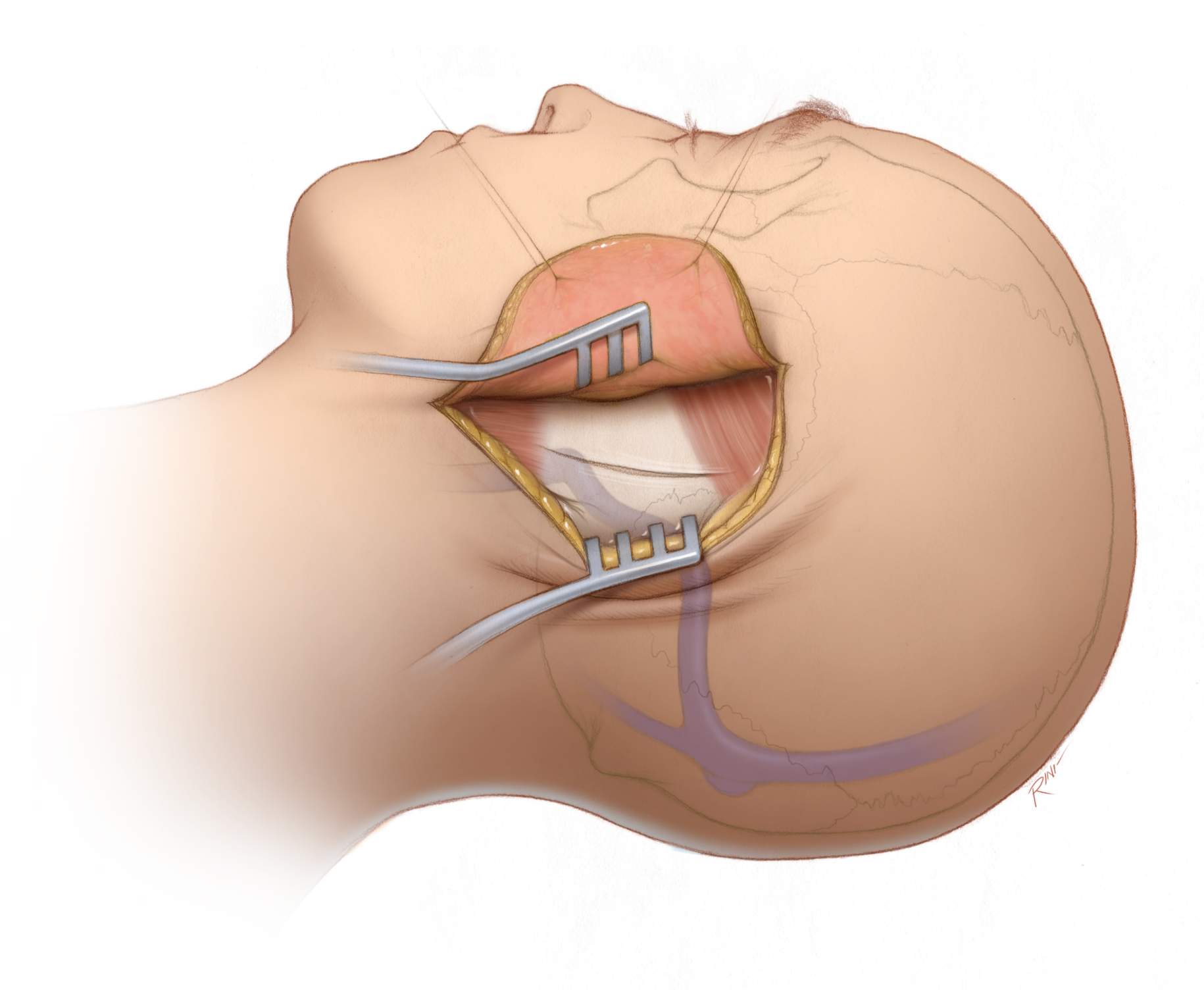 Figura 6: incisión y craneotomía para el abordaje translaberíntico