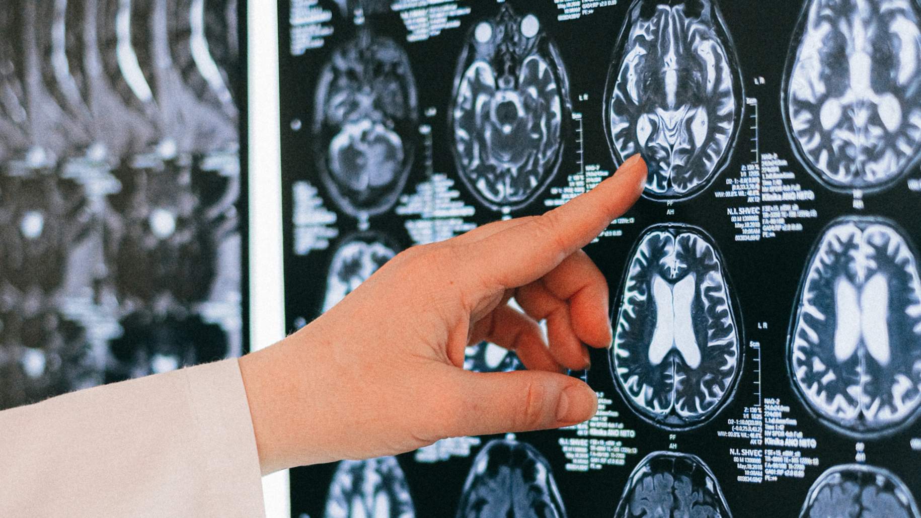 
                                    
                                        علاج التشوه الشرياني الوريدي بالأشعة التداخلية
                                    
                                