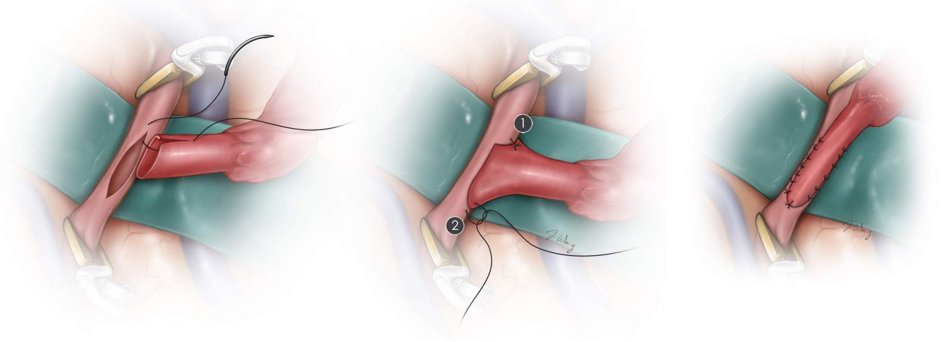 
                                    
                                        Figura 5. (Arriba) Se ilustran las suturas iniciales de la anastomosis. (Abajo) Se muestra el producto final de la derivación de STA-MCA.
                                    
                                