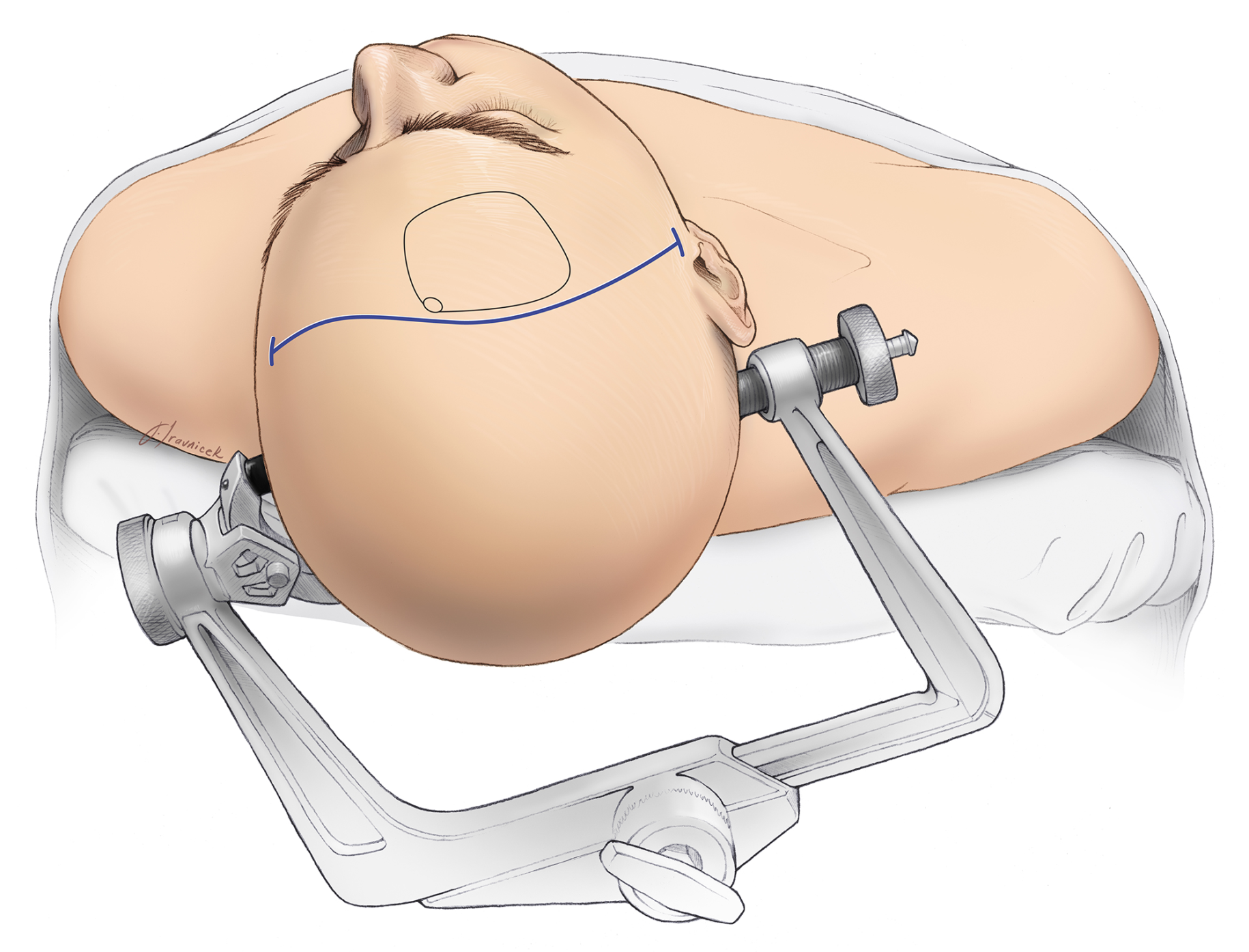 Figure 1: A 3-pin skull clamp is used to fix the head in the optimal position for surgery.