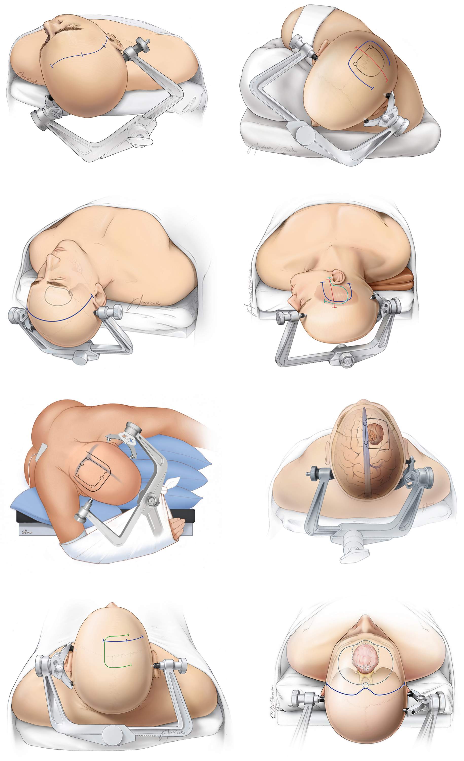 Figure 2. Craniotomies are named on the basis of their corresponding bones or anatomical landmarks. Incision lines are drawn. From top to bottom and left to right, the craniotomies are named as pterional (or frontotemporal), parietal, supraorbital, subtemporal, occipital, parasagittal, interhemispheric, and bifrontal.