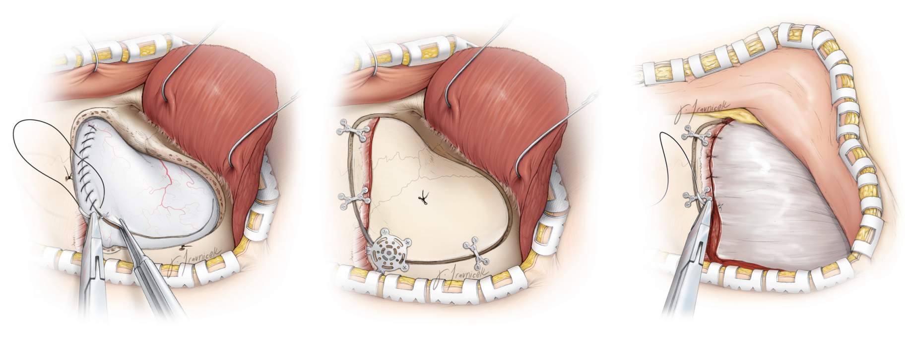 
                                    
                                        Figure 8. The dura (left), bone flap (middle), and muscle and connective tissues (right) are reattached with sutures for tissue and metal plates for bone.
                                    
                                