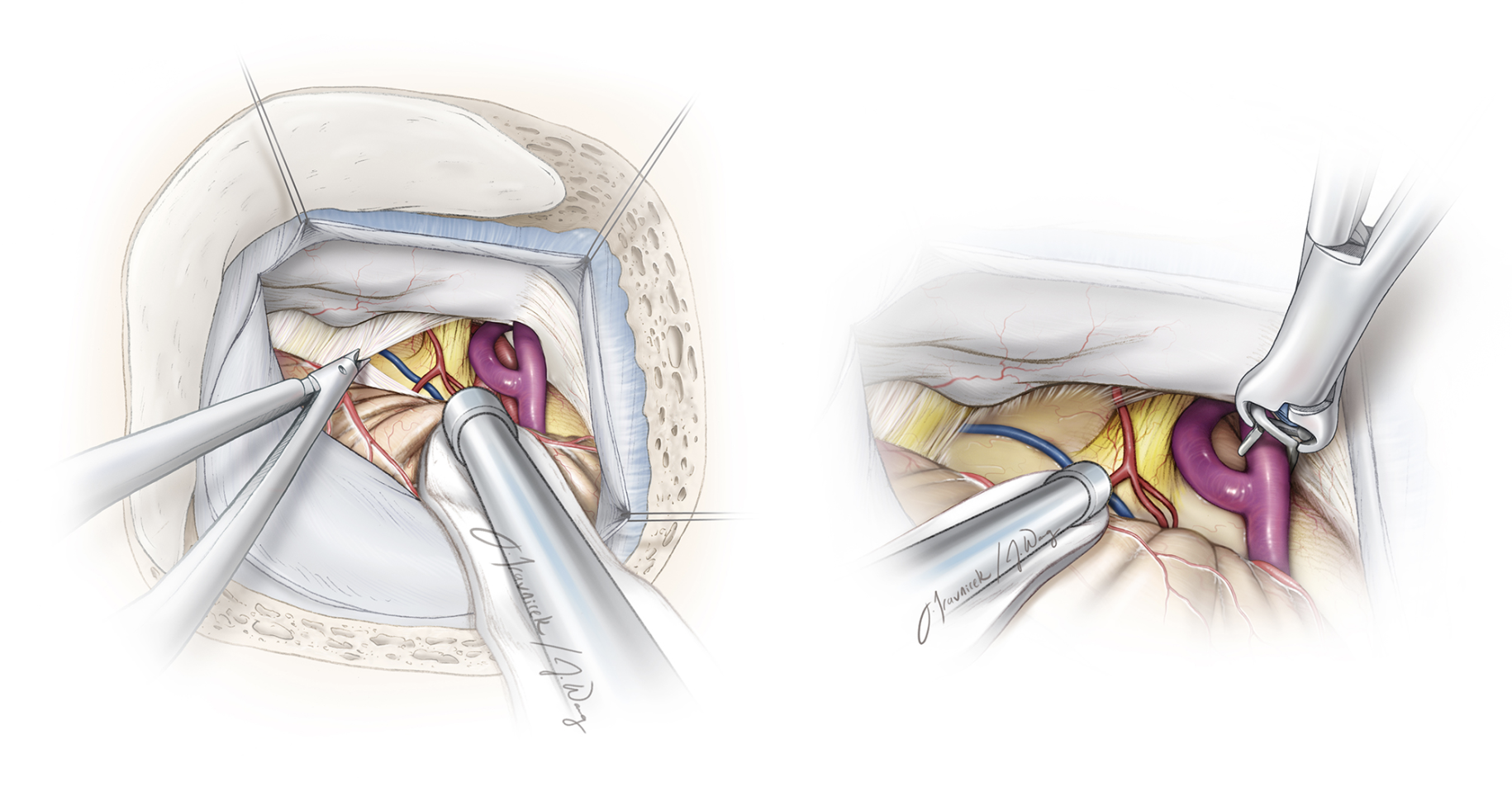 Figure 1: Illustration of microsurgical clipping of a skull base dAVF.