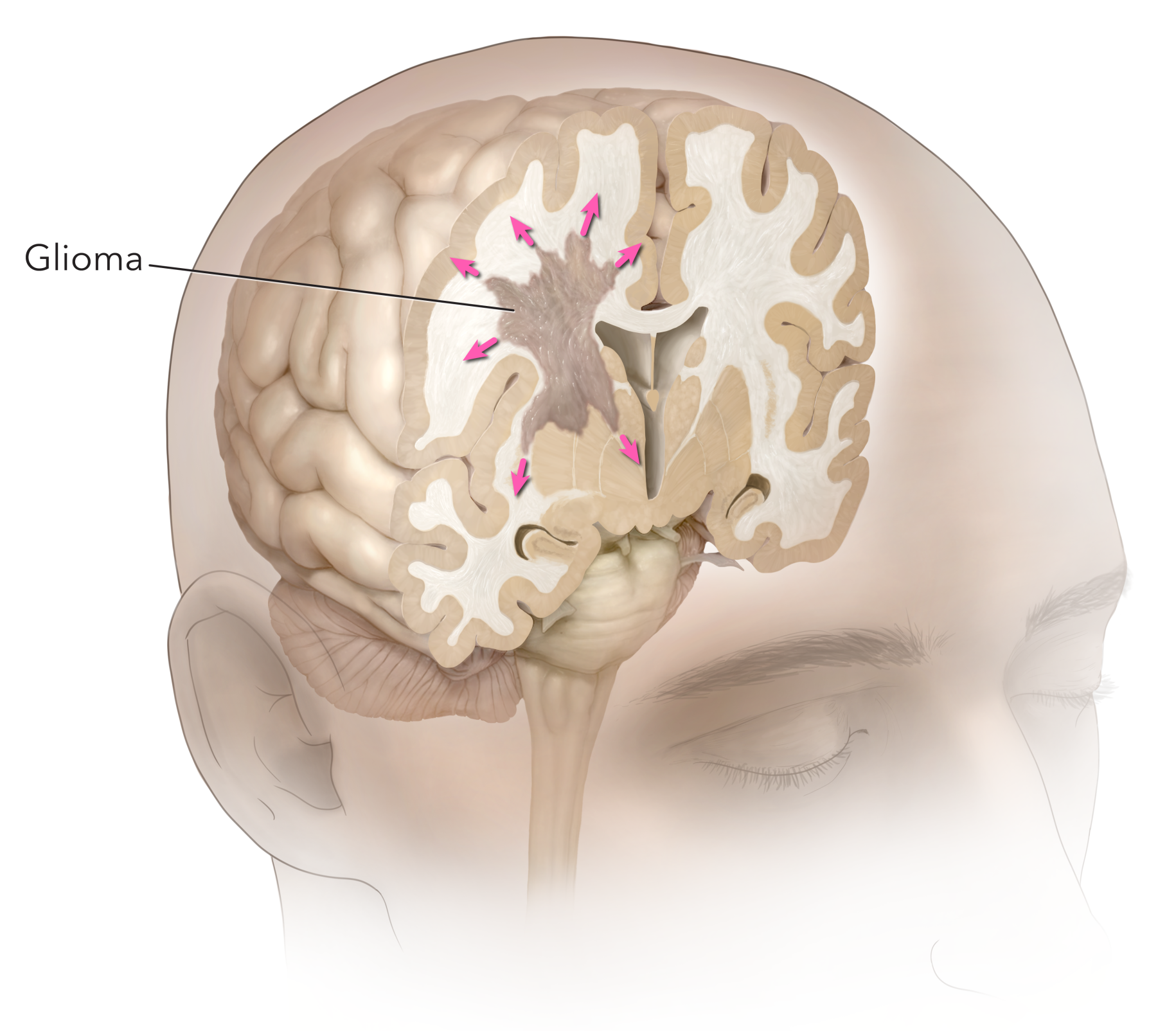 Figure 1: Glioma.