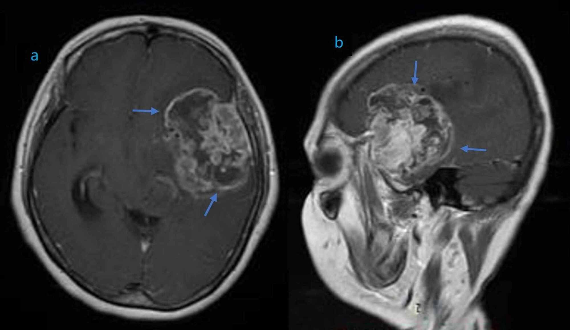 
                                    
                                        Figura 1: Esta resonancia magnética demuestra un glioma de alto grado en los lóbulos temporal y frontal izquierdos.
                                    
                                