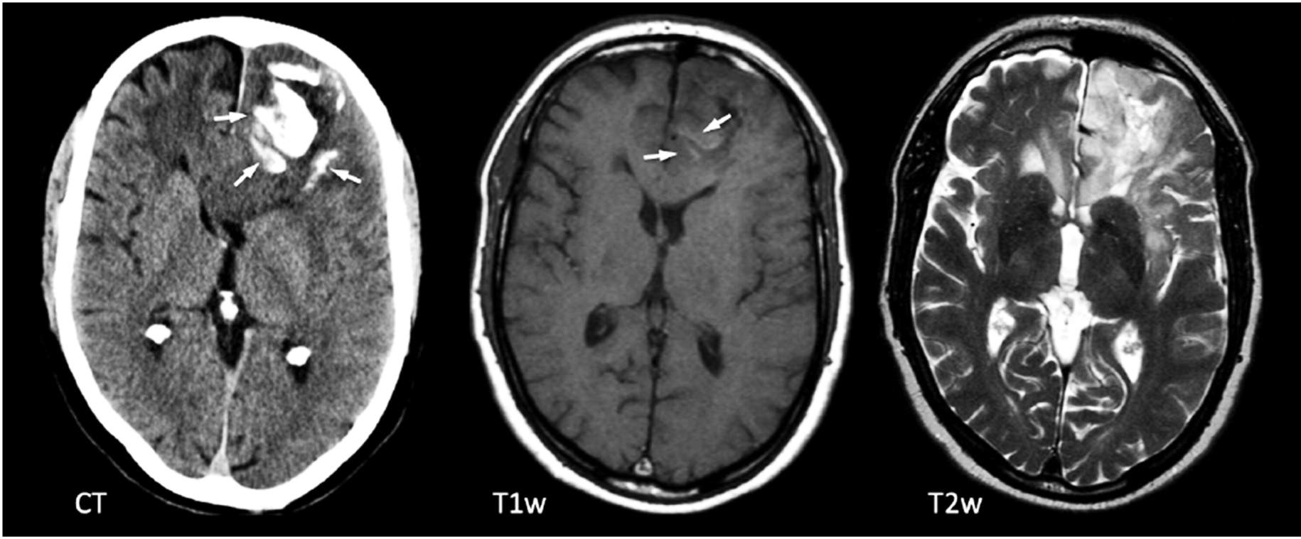 Figura 1: TC (izquierda) y RM (2 imágenes de la derecha) muestran calcificaciones (flechas) en TC en el lóbulo frontal izquierdo, muy características de un oligodendroglioma.