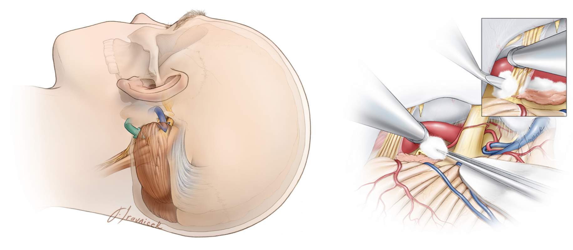 Figure 2. Area of the operation (left) and placement of packing material between the artery and nerve root to decompress the nerve (right).