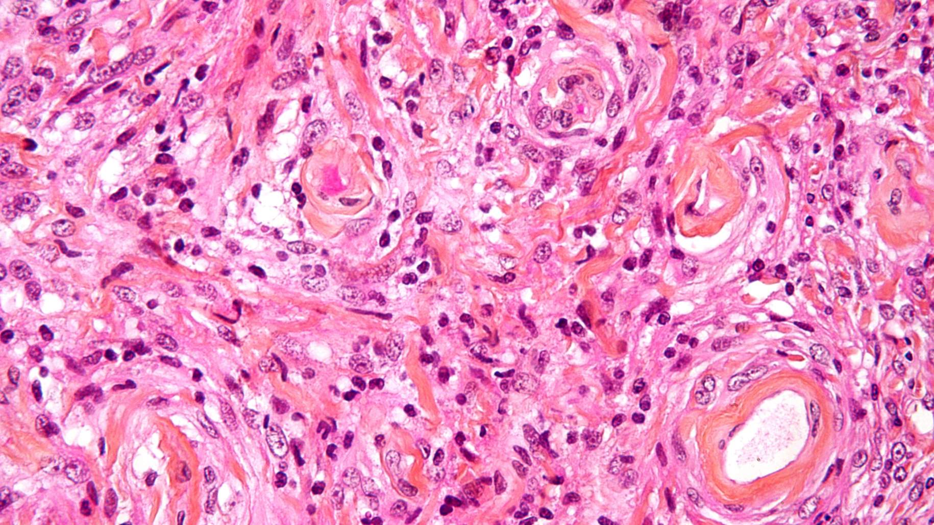 Figura 2. Un ejemplo de meningioma grado I bajo el microscopio.