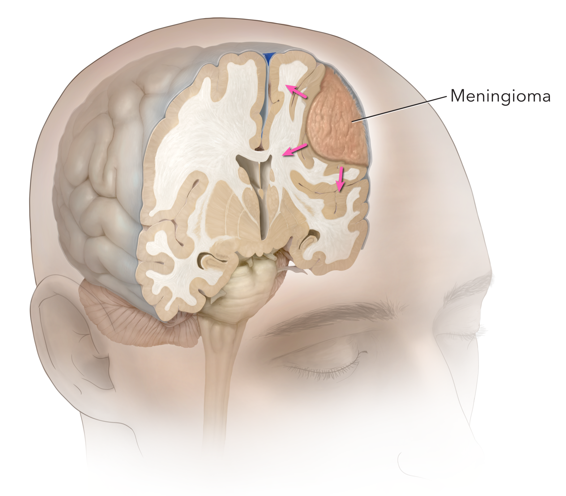 Figura 1. Se demuestra un meningioma frontal izquierdo que se origina en la cubierta del cerebro (meninges) y que comprime el cerebro.