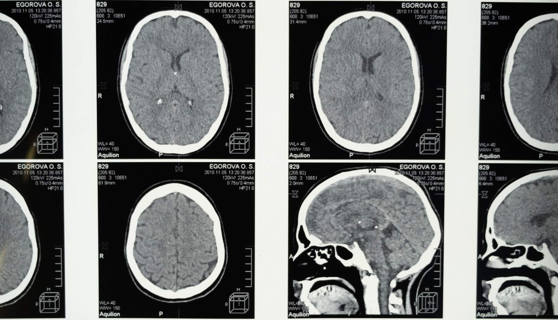 diagnosis of meningioma