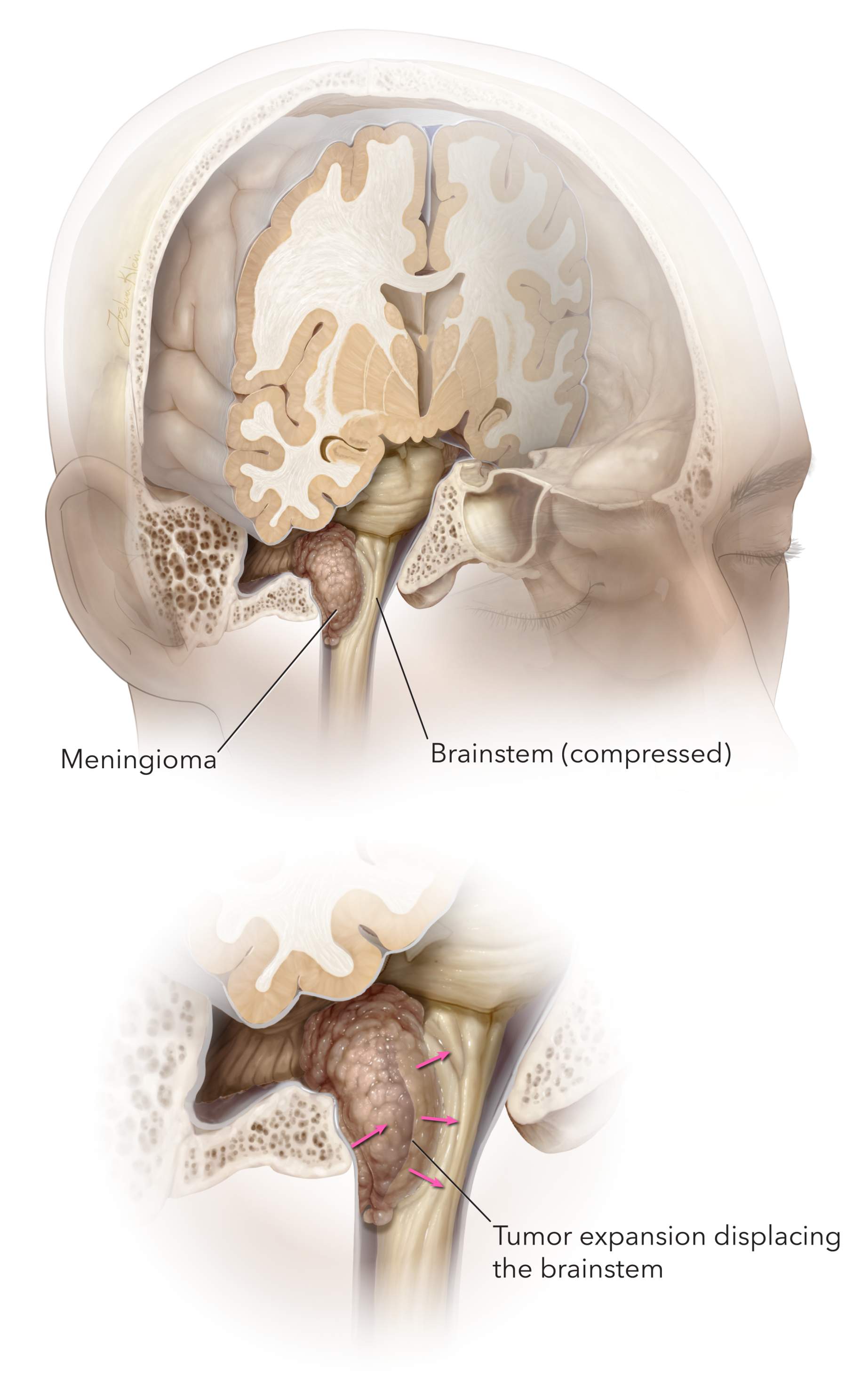 Figure 1. This illustration demonstrates a meningioma compressing the brainstem. An attempt at complete surgical removal is the best course of treatment.