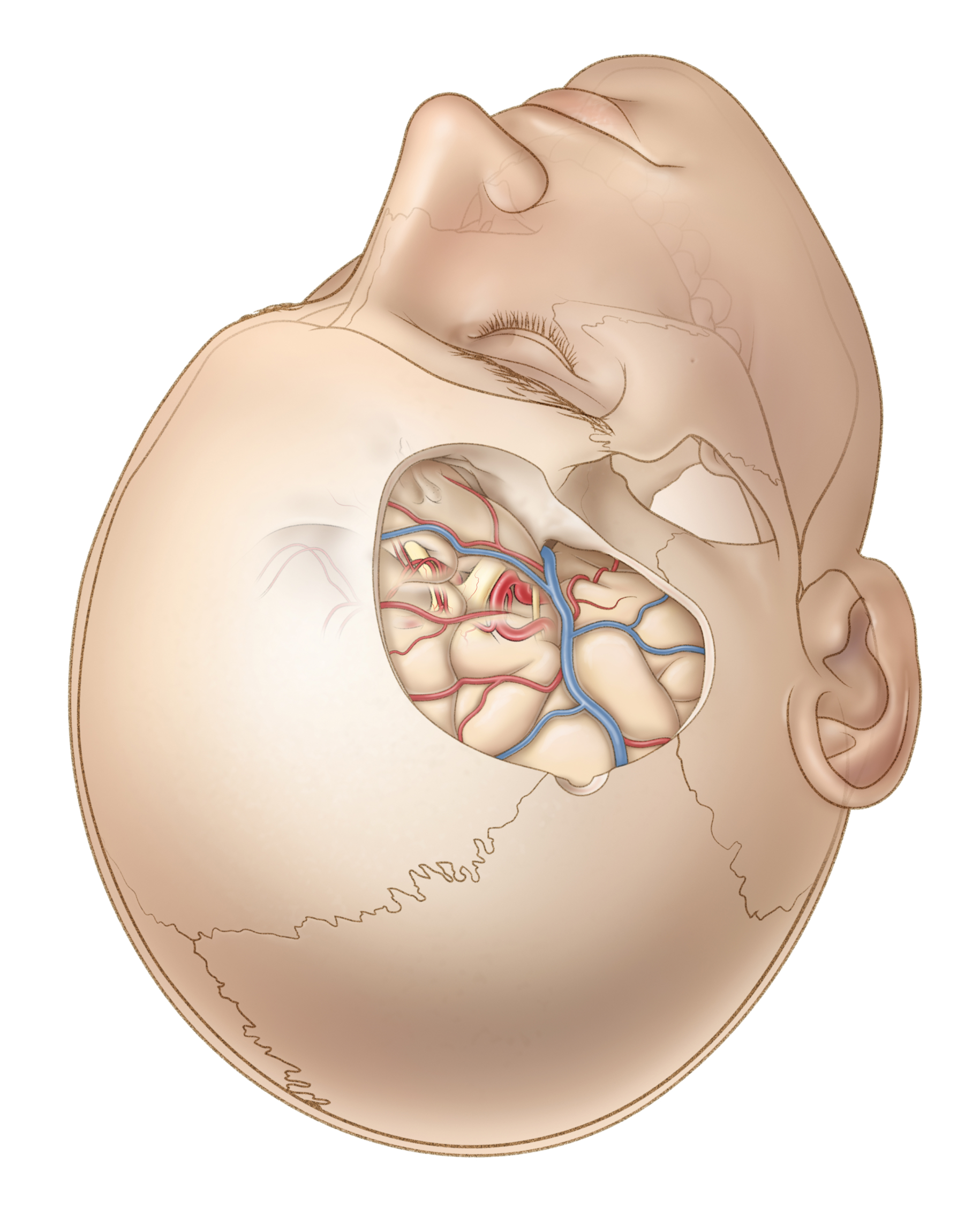 Figure 3. Transcranial approach.