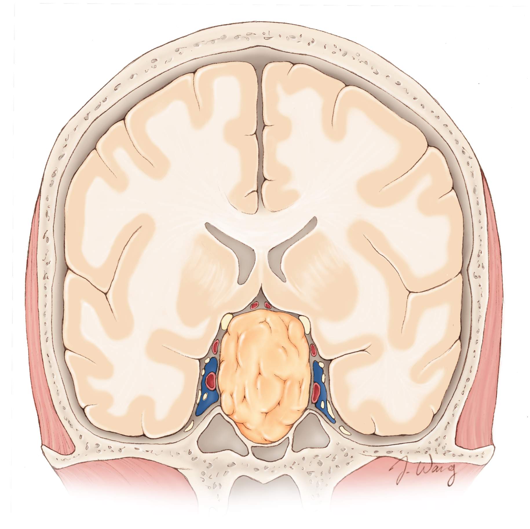 
                                    
                                        Figura 1. Corte transversal de un tumor hipofisario en la base del cráneo.
                                    
                                