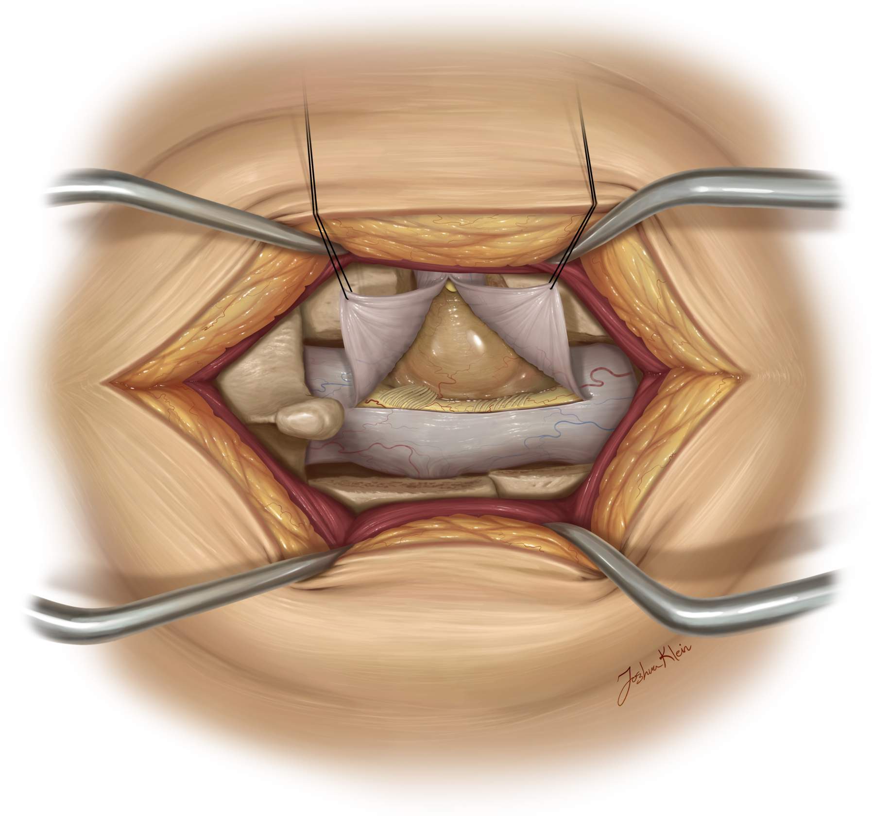 
                                    
                                        Figure 2: During spinal cord tumor surgery, surgeons carefully cut through layers of skin, bone (spine), and other tissues until they reach the spinal cord and tumor.
                                    
                                