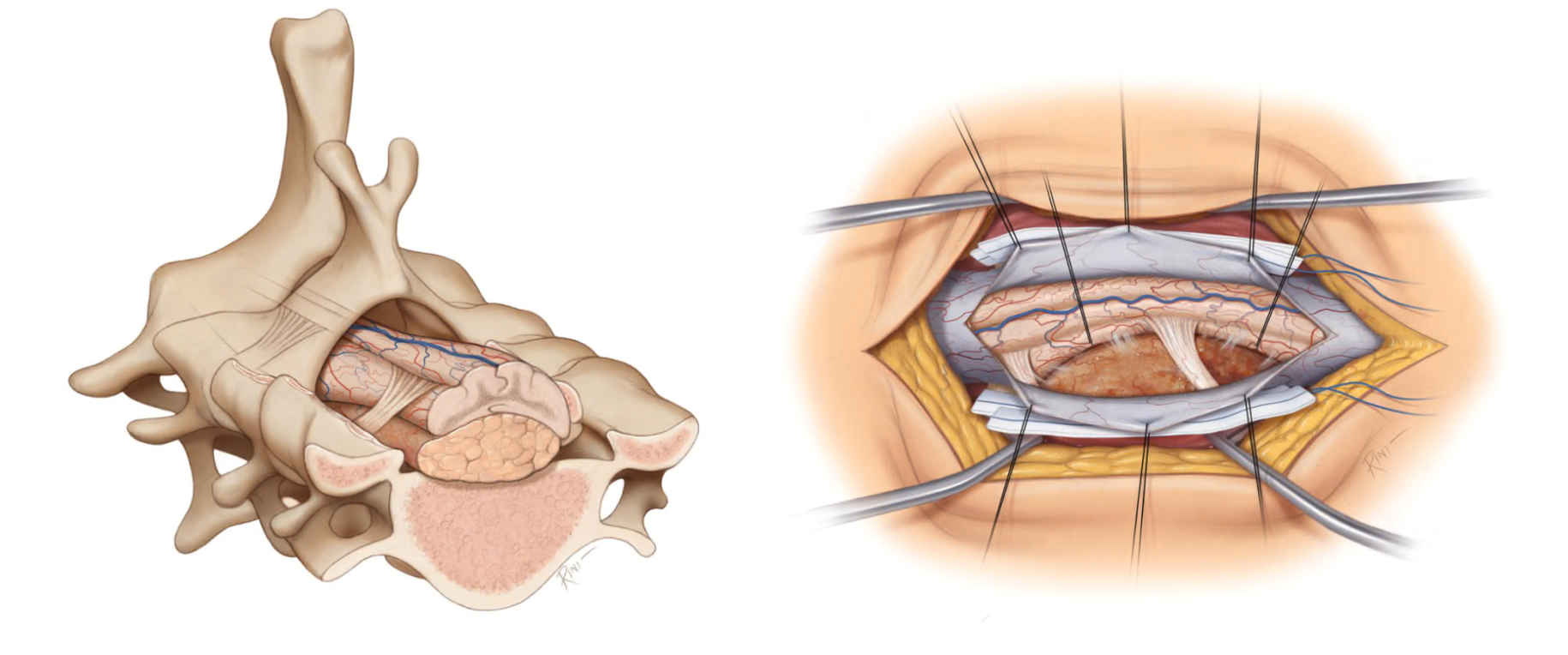 An illustration of a spinal cord meningioma in cross section and operative views, compressing the spinal cord.