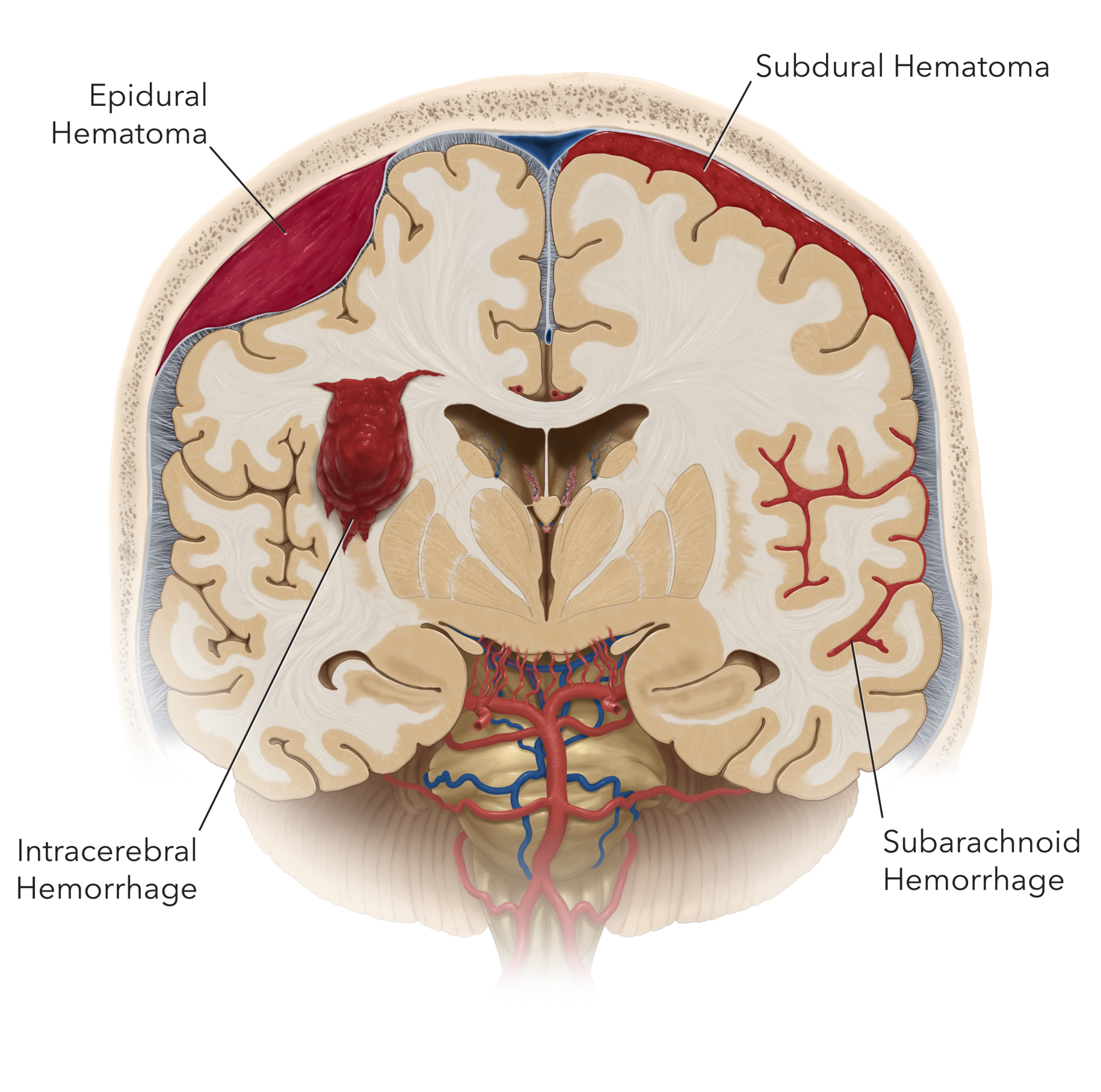 Figure 1. Different types of intracranial hemorrhage. In subarachnoid hemorrhage, blood accumulates in the space surrounding the brain after aneurysm rupture. This is different than hemorrhage or bleeding on the brain (subdural or epidural hematoma) and within the brain (intracerebral hemorrhage/hematoma).