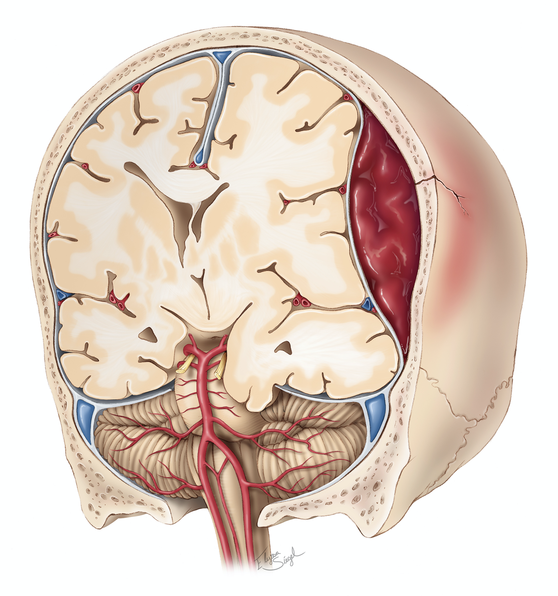 
                                    
                                        Figure 2: A large epidural hematoma is formed after blunt injury to the skull. This expanding collection of blood will push the brain towards the other side and can damage critical brain structures.
                                    
                                