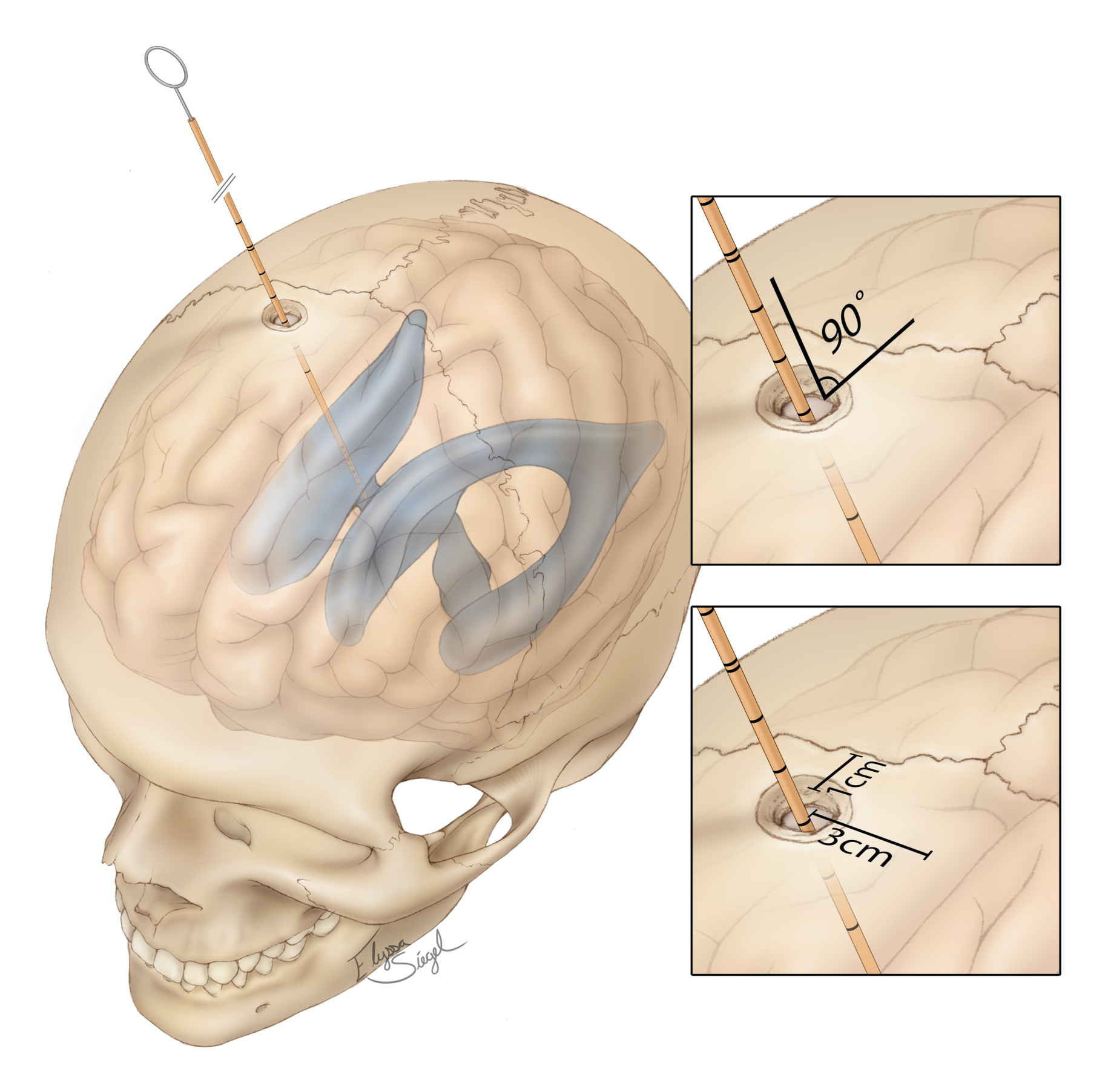 
                                    
                                        Figure 5: Placement of the catheter into a ventricle of the brain.  
                                    
                                