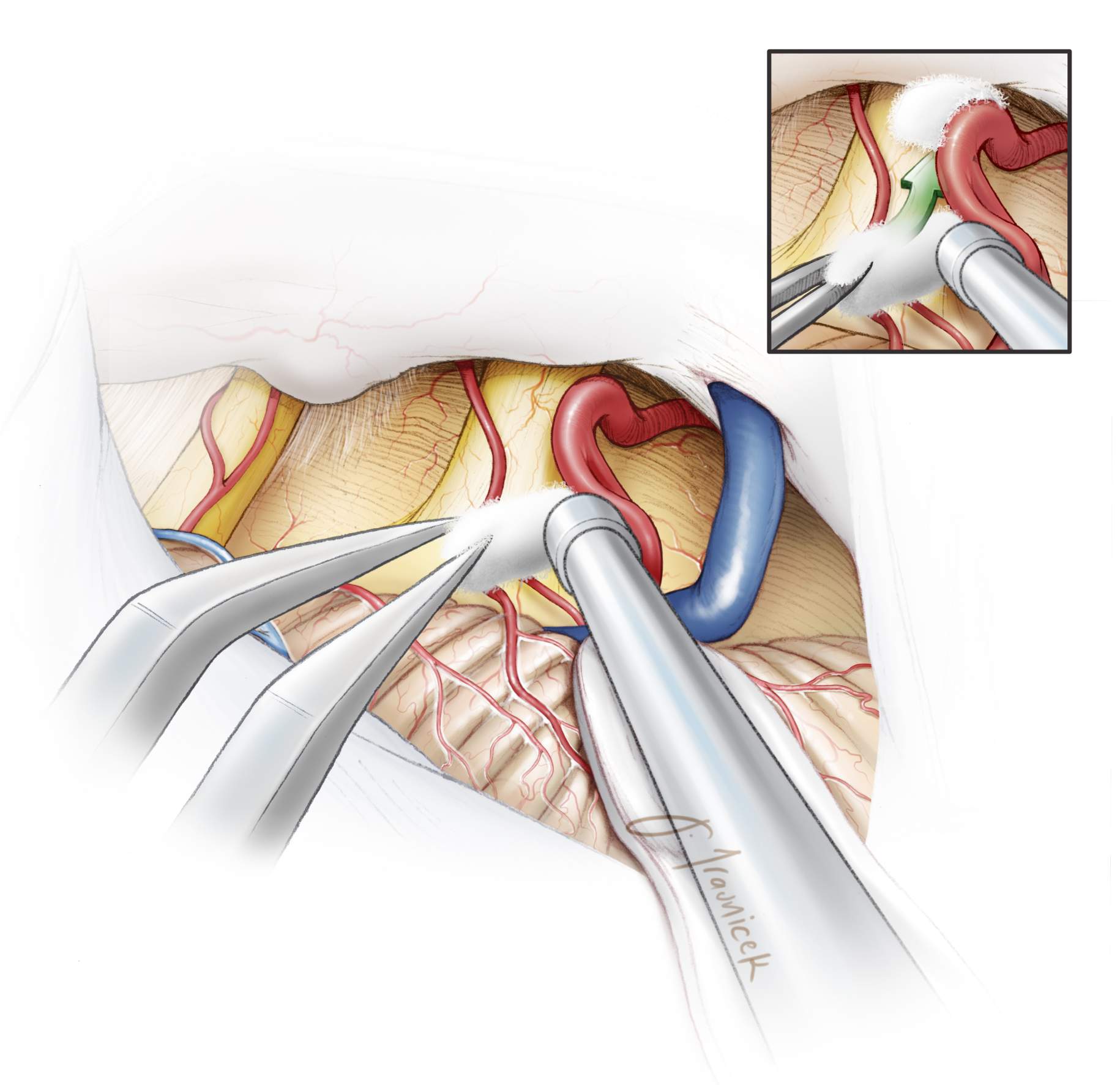 Decompression of the Trigeminal Nerve Using Teflon Padding